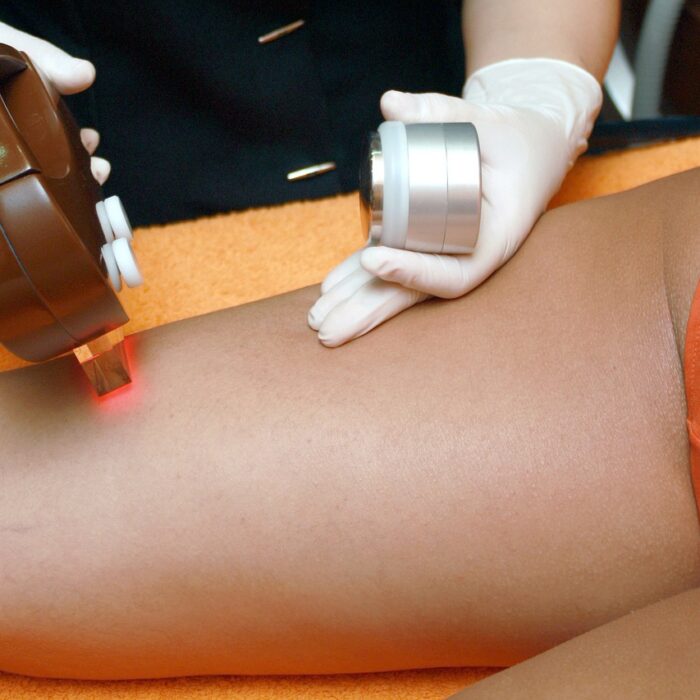 Épilation laser maillot : résultats et tarifs